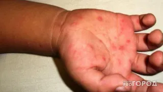 В Рязани еще один ребенок заболел вирусом Коксаки - комментарий врача