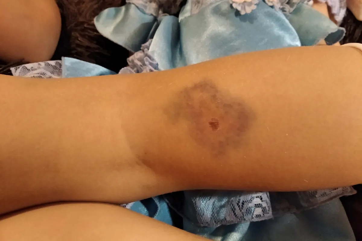 В Приокском на детской площадке бродячие собаки покусали 9-летнюю девочку