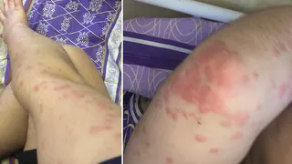 Руки и ноги в укусах: пациент ОКБ снял на фото последствия встречи с больничными клопами